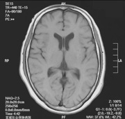 MRI画像